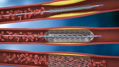 Découvre l'Angiodysplasie : Une Anomalie Vasculaire Qui N'aime Pas Passer Inaperçue !