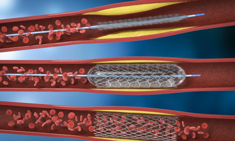 Découvre l'Angiodysplasie : Une Anomalie Vasculaire Qui N'aime Pas Passer Inaperçue !