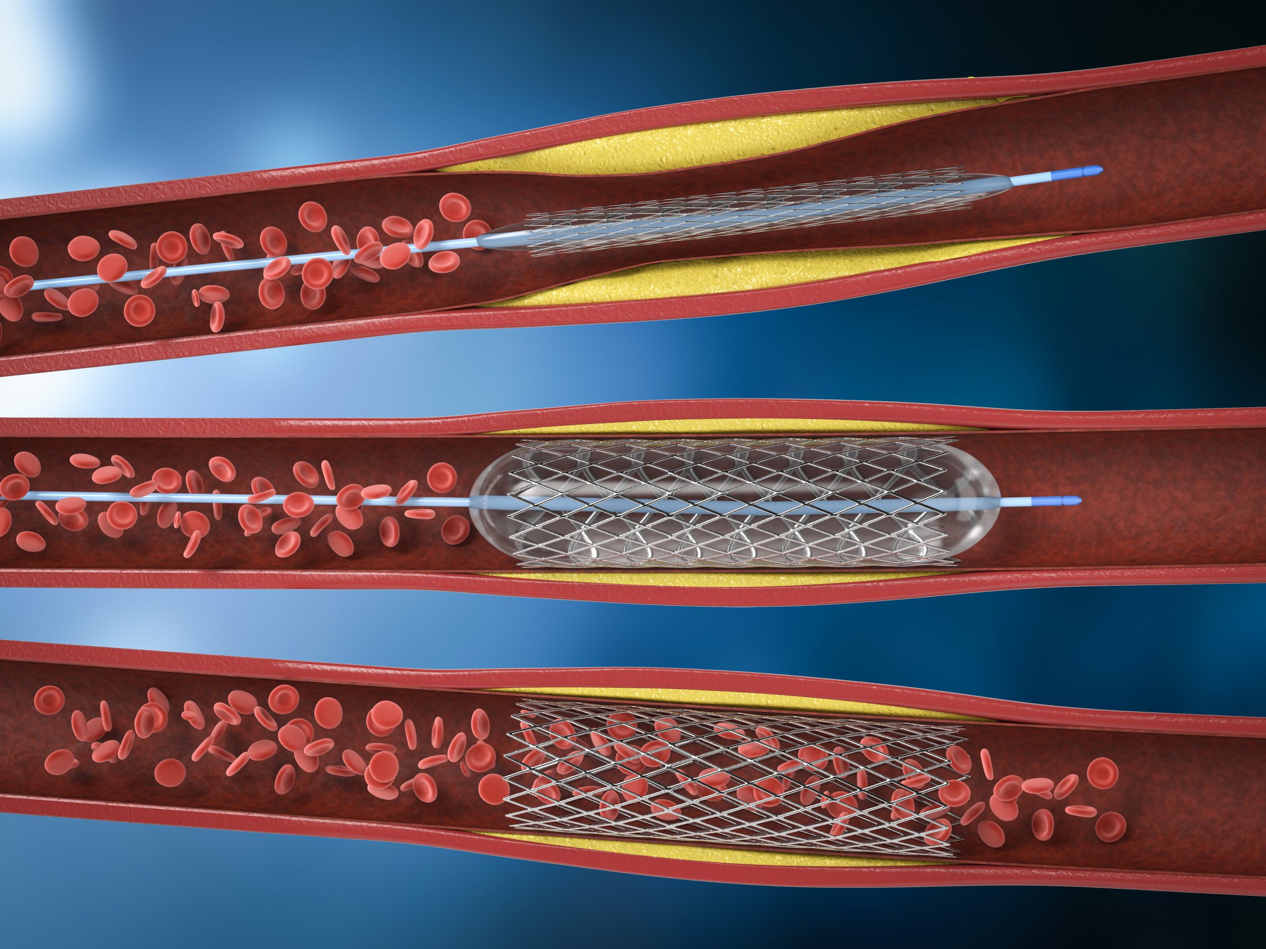 Découvre l'Angiodysplasie : Une Anomalie Vasculaire Qui N'aime Pas Passer Inaperçue !