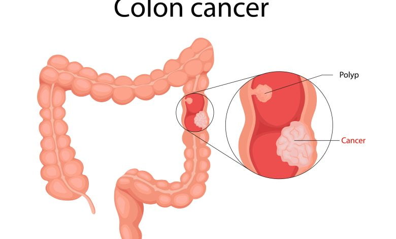 Explorez les aliments quotidiens qui se révèlent être des alliés puissants dans la prévention du cancer du côlon.