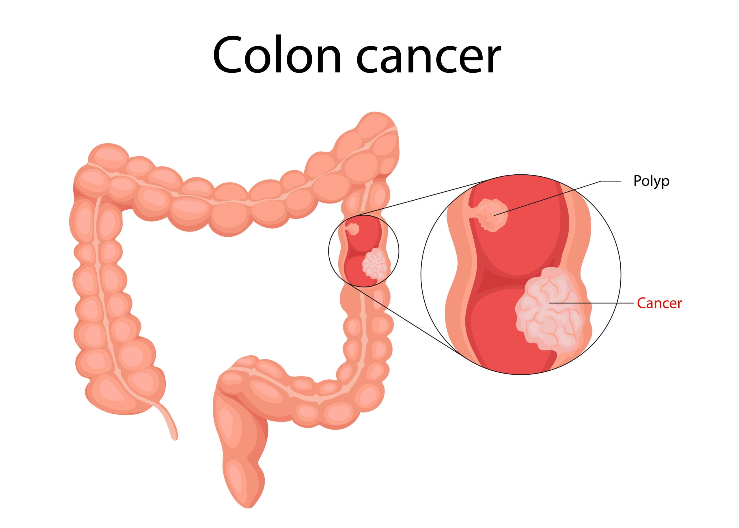 Explorez les aliments quotidiens qui se révèlent être des alliés puissants dans la prévention du cancer du côlon.