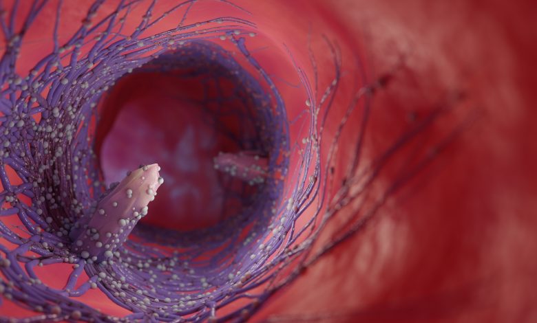 Exploration approfondie des symptômes, diagnostics et options de traitement de l'Œsophagite Éosinophilique.