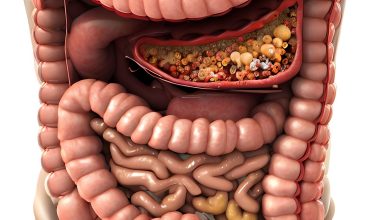 Comprendre les Symptômes, Causes et Traitements de la Diverticulite et de la Diverticulose