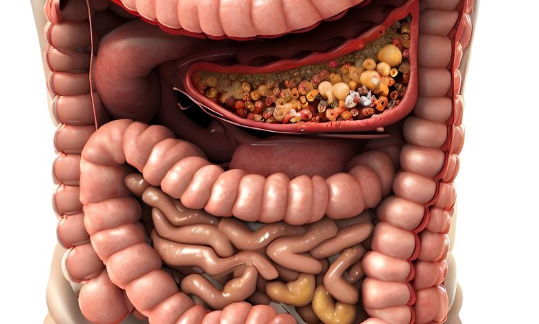 Comprendre les Symptômes, Causes et Traitements de la Diverticulite et de la Diverticulose