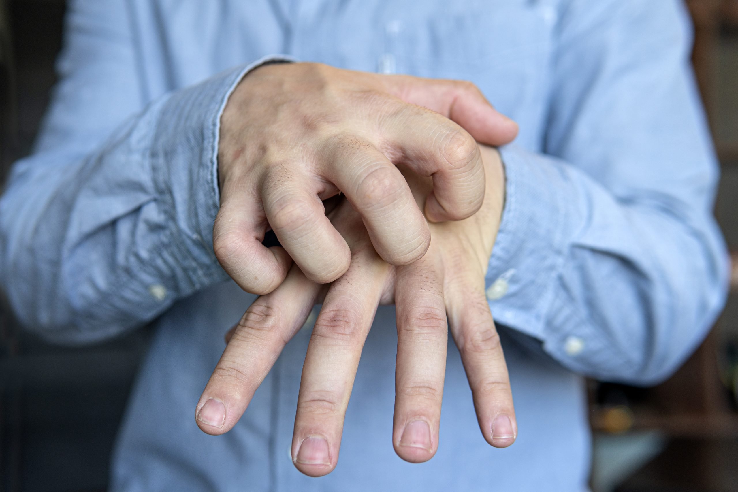 Démystifier l'algodystrophie Comprendre, Diagnostiquer et Gérer cette Affection Énigmatique