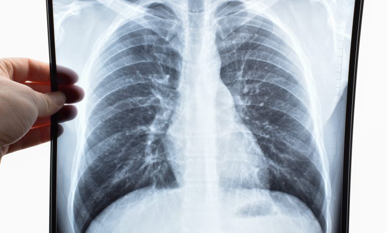 Plongez dans l'univers des pneumoconioses, comprenez l'impact de l'anthracose et de l'asbestose sur la santé pulmonaire.