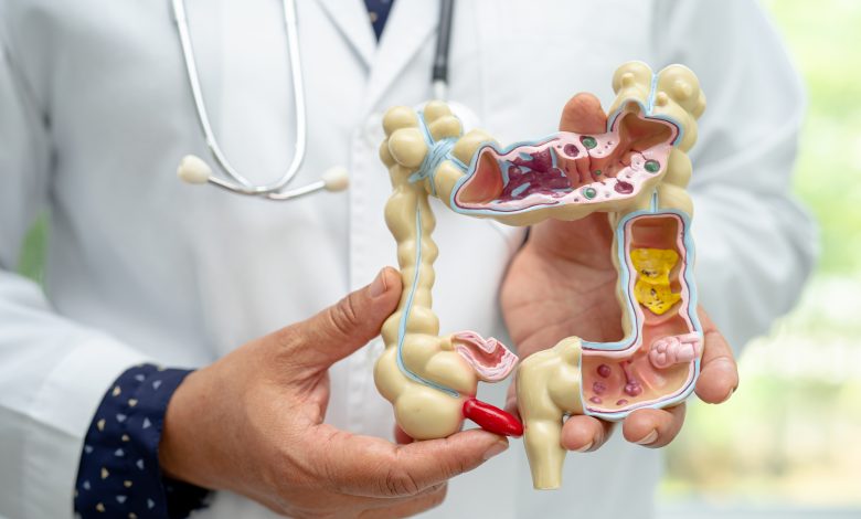 Découvrez les Types, Symptômes, Prévention et Traitement des Polypes du côlon pour une Santé Optimale