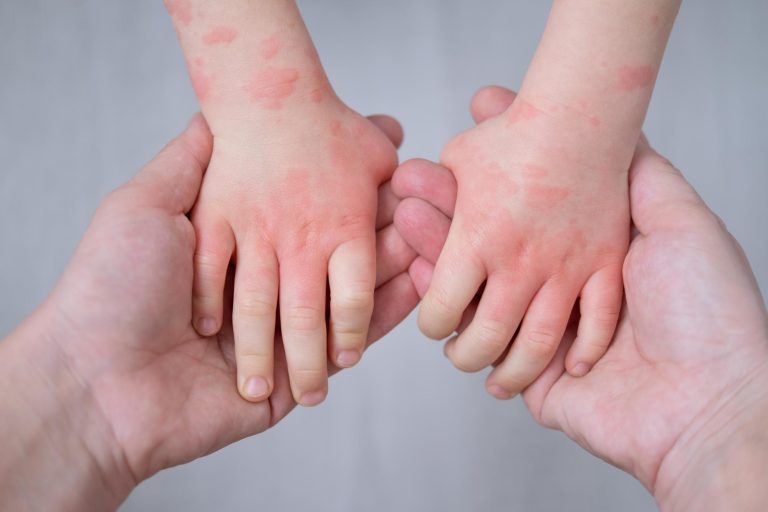 Comprendre le syndrome piedmainbouche Révélations Sante Presse Actualité Santé