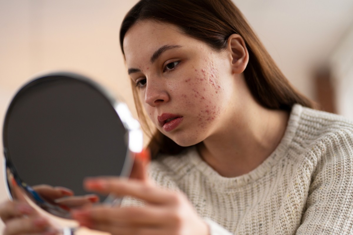 Révélation la bactérie de l’Acné, un allié Insoupçonné pour une peau saine et équilibrée