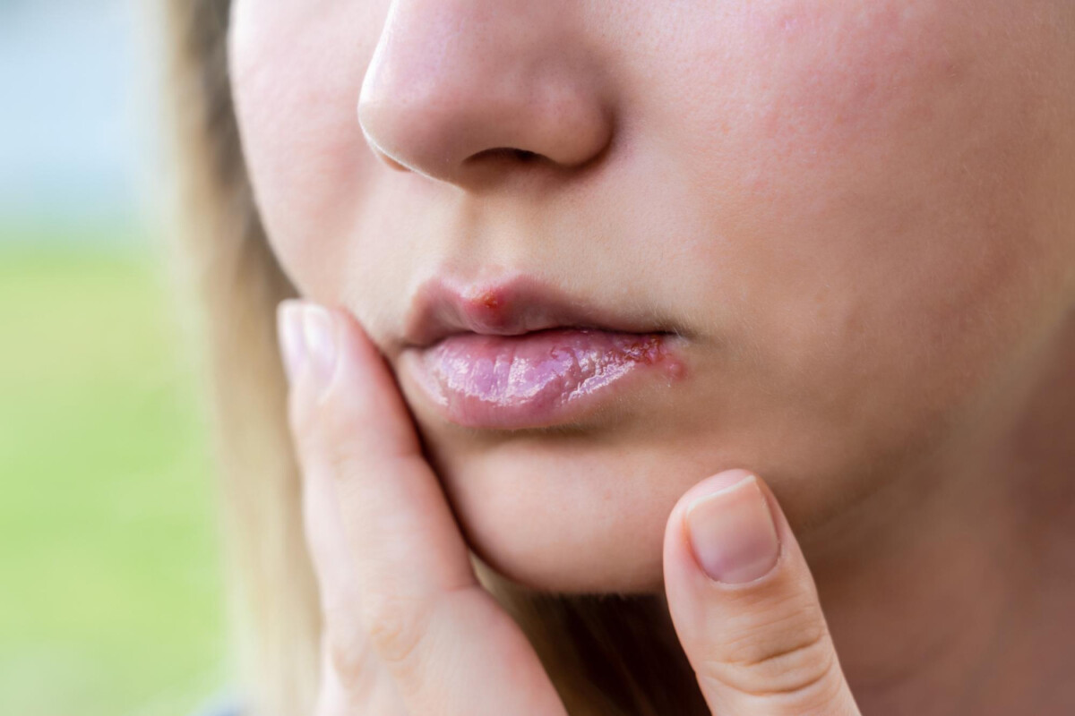 Des astuces efficaces pour faire disparaître les boutons de fièvre et éviter les récidives