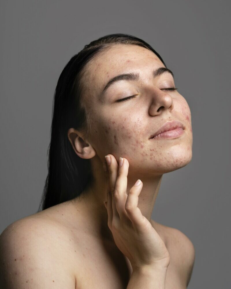 portrait-jeune-femme-confidente-avec-acné