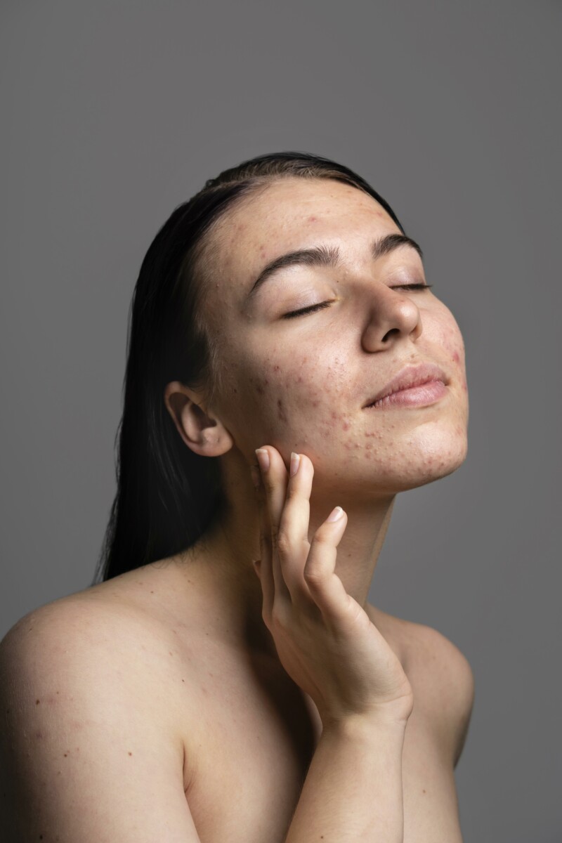 portrait-jeune-femme-confidente-avec-acné