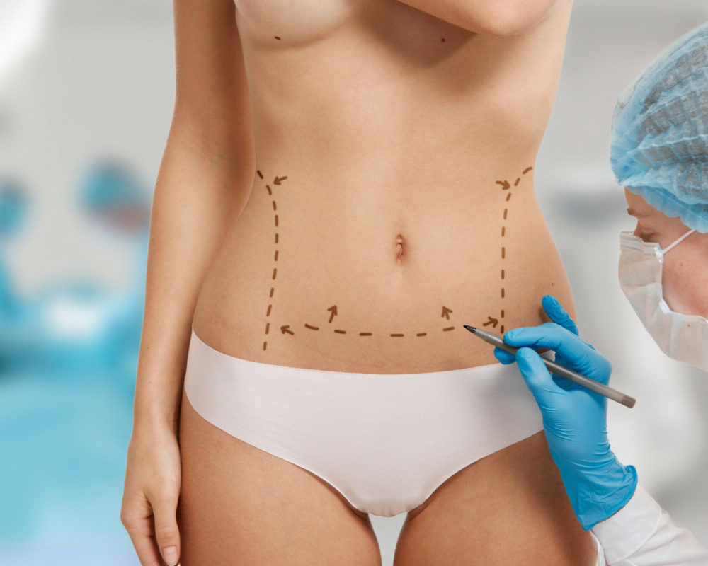 Sculptez votre abdomen découvrez tout sur l'abdominoplastie et ses avantages pour votre silhouette !