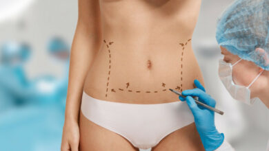 Sculptez votre abdomen découvrez tout sur l'abdominoplastie et ses avantages pour votre silhouette !