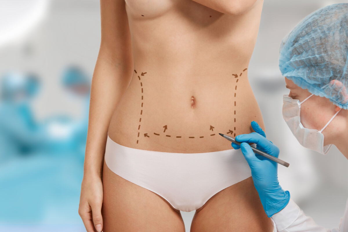 Sculptez votre abdomen découvrez tout sur l'abdominoplastie et ses avantages pour votre silhouette !