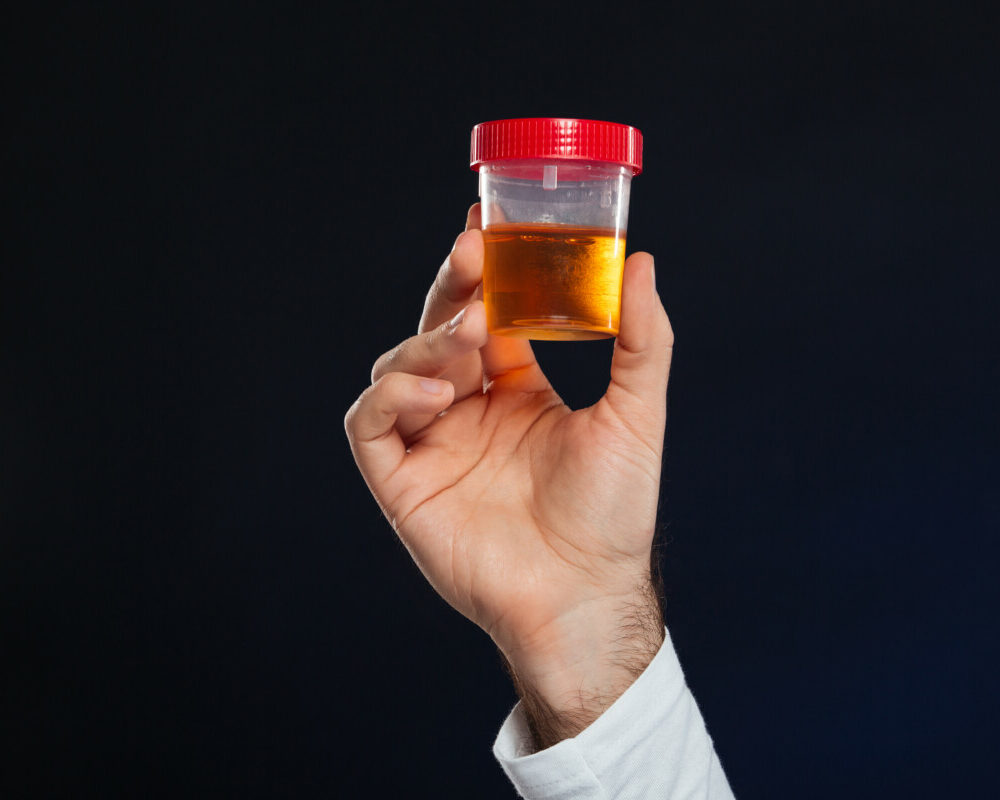 close-up-male-s-hand-holding-container-with-urine-sample