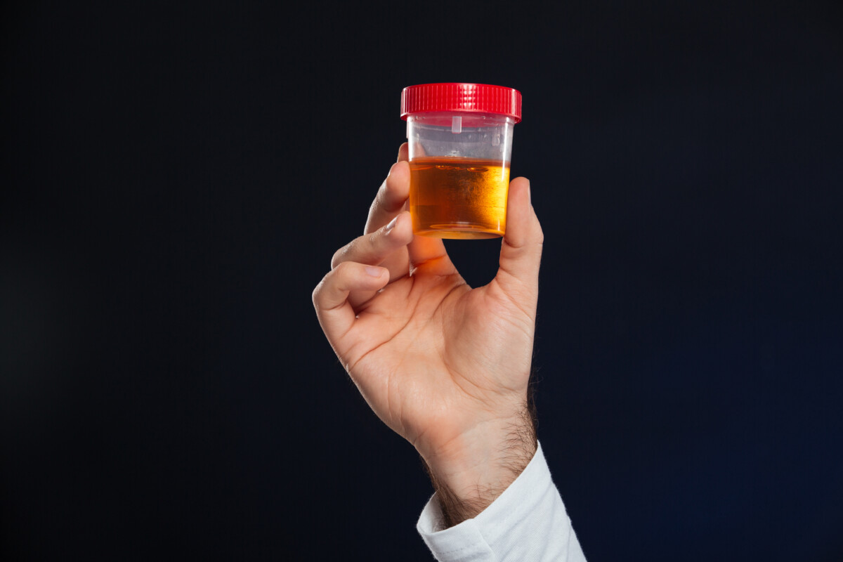 close-up-male-s-hand-holding-container-with-urine-sample