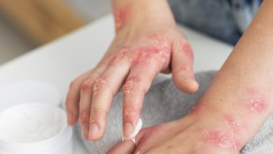 hands-patient-suffering-from-psoriasis-épidémie-rougeole