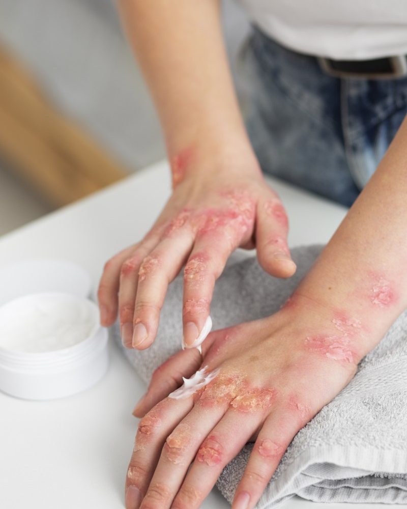 hands-patient-suffering-from-psoriasis-épidémie-rougeole