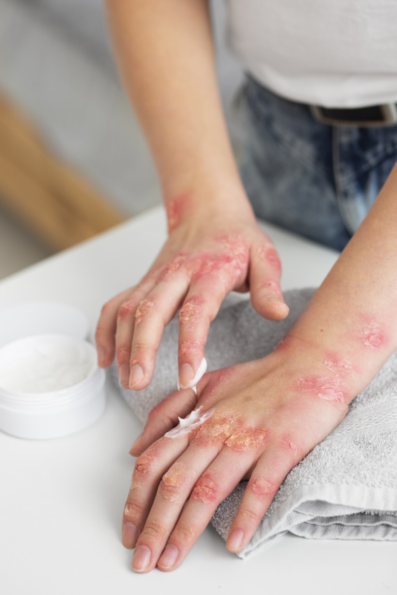 hands-patient-suffering-from-psoriasis-épidémie-rougeole